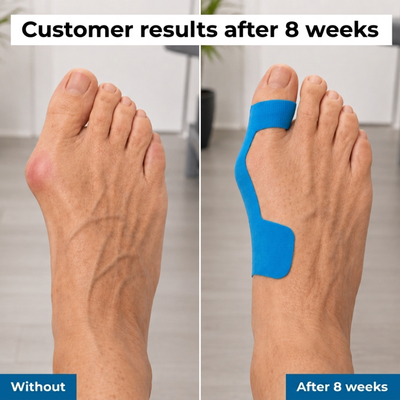 APRIS™ - Hallux-Valgus